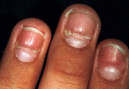 causes of nail abnormalities