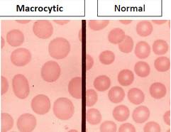 medical zone - macrocytic anemia 