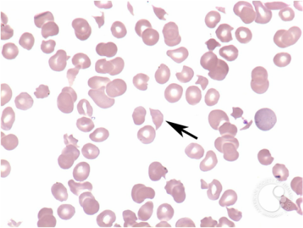medical zone - hemolytic anemia 
