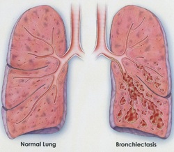 clinical examination of bronchiectasis