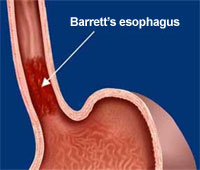 pathology of barrett esophagus