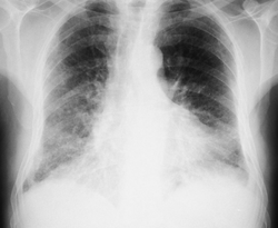 clinical examination of basal pulmonary fibrosis 