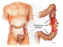 pathology of diverticular disease