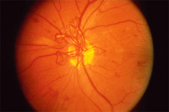 differential diagnosis of retinal neovascularization 