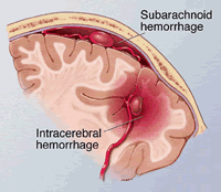 Pathology of subarachnoid hemorrhage