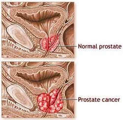 pathology definition of prostate carcinoma 