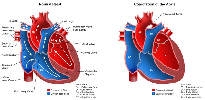 Pediatric definition - coarctation of aorta 