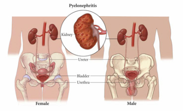 pathology of pyelonephritis 