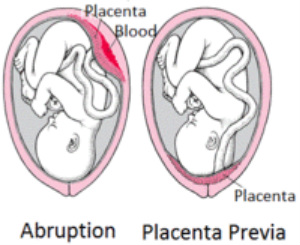 pathology of abnormal placenta attachment 