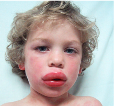 Pediatric definition - anaphylaxis 