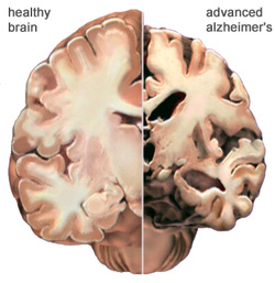 pathology of alzheimer disease