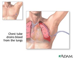 how to insert chest drain 