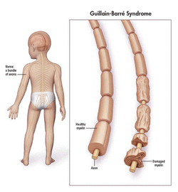 pathology of guillain barre syndrome 
