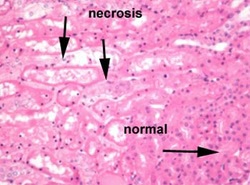 Pathology of acute tubular necrosis 