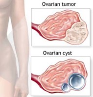 pathology of ovarian tumor 