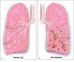 Pathology of bronchiectasis 