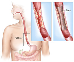 pathology of esophageal carcinoma