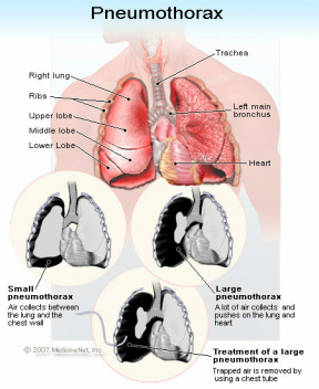pathology of pneumothorax