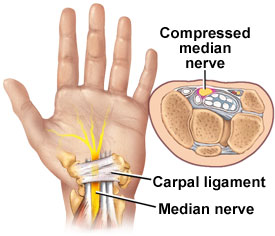 medical zone - carpal tunnel syndrome 