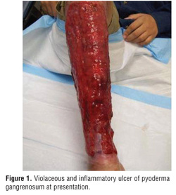 pathology of bruton agammaglobulinemia 