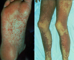 pathology of graft versus host disease