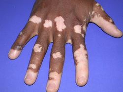 pathology of vitiligo 