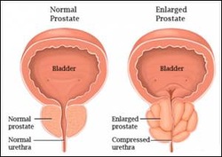 pathology of benign prostatic hyperplasia 