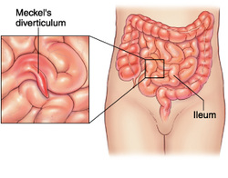 pathology of meckel diverticulum 