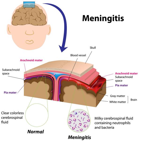 Pediatric definition - brain meningitis 