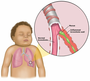 Pediatric Definition - Bronchiolitis 