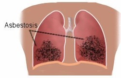 Pathology of asbestosis 