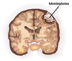 pathology of meningioma 
