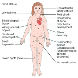 pathology of turner syndrome 
