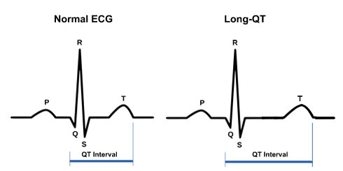 differential diagnosis of long qt interval 
