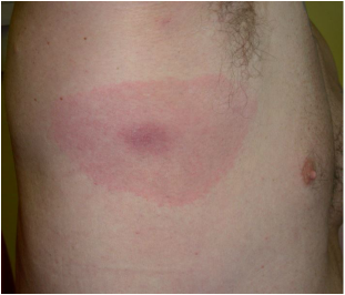 medical zone - axillary erythematous rash 