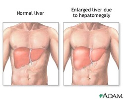 clinical examination of hepatomegaly 