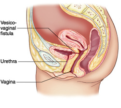How to treat urinary tract fistula 
