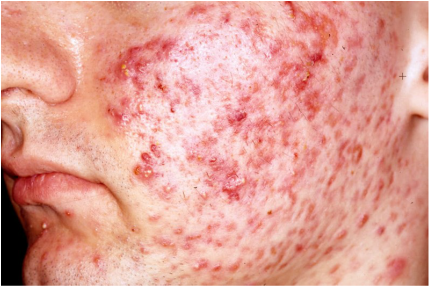 acne vulgaris treatment 