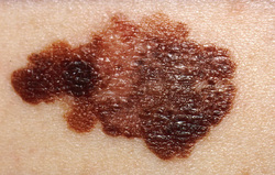 pathology of malignant melanoma 