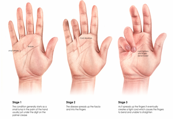 medical zone - dupuytren contracture 