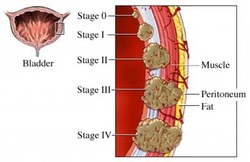 Pathology of bladder transitional cell carcinoma 