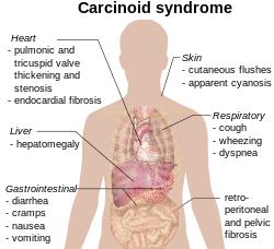 pathology of carcinoid syndrome