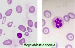 pathology of megaloblastic anemia 