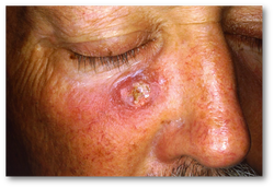 pathology of squamous cell carcinoma of the skin 