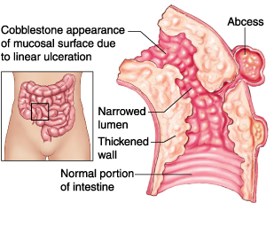 Pediatric Definition - Crohn Disease