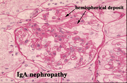 pathology of IgA nephropathy 