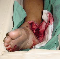 How to treat open fracture