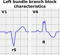 medical zone - left bundle branch block 