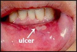 symptom finder- the causes of mouth ulcers
