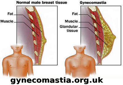 medical zone - gynecomastia 